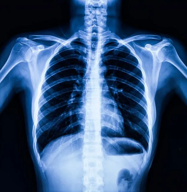Illustrative image: Lung scarring (ILD)