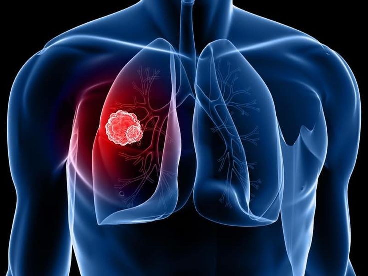 Medical illustration of the lungs showing a highlighted area that requires clinical assessment.